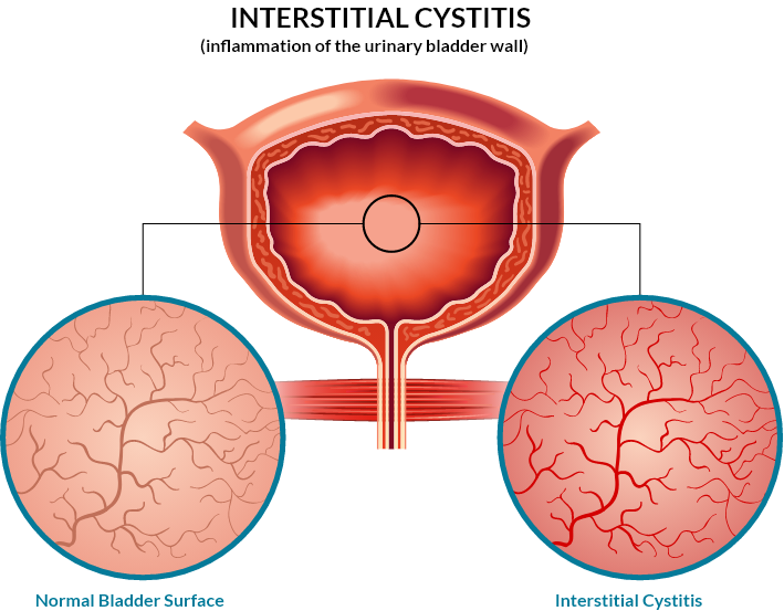 Image of a bladder with two close-ups of the internal wall which compare a normal bladder surface with one that has interstitial cystitis which has redder capillaries. The available interstitial cystitis treatment options do not meet the needs of most patients. 